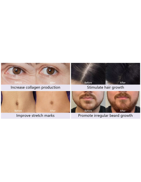 Dr. Pen Аппарат фракционной мезотерапии Dermapen A10, беспроводное